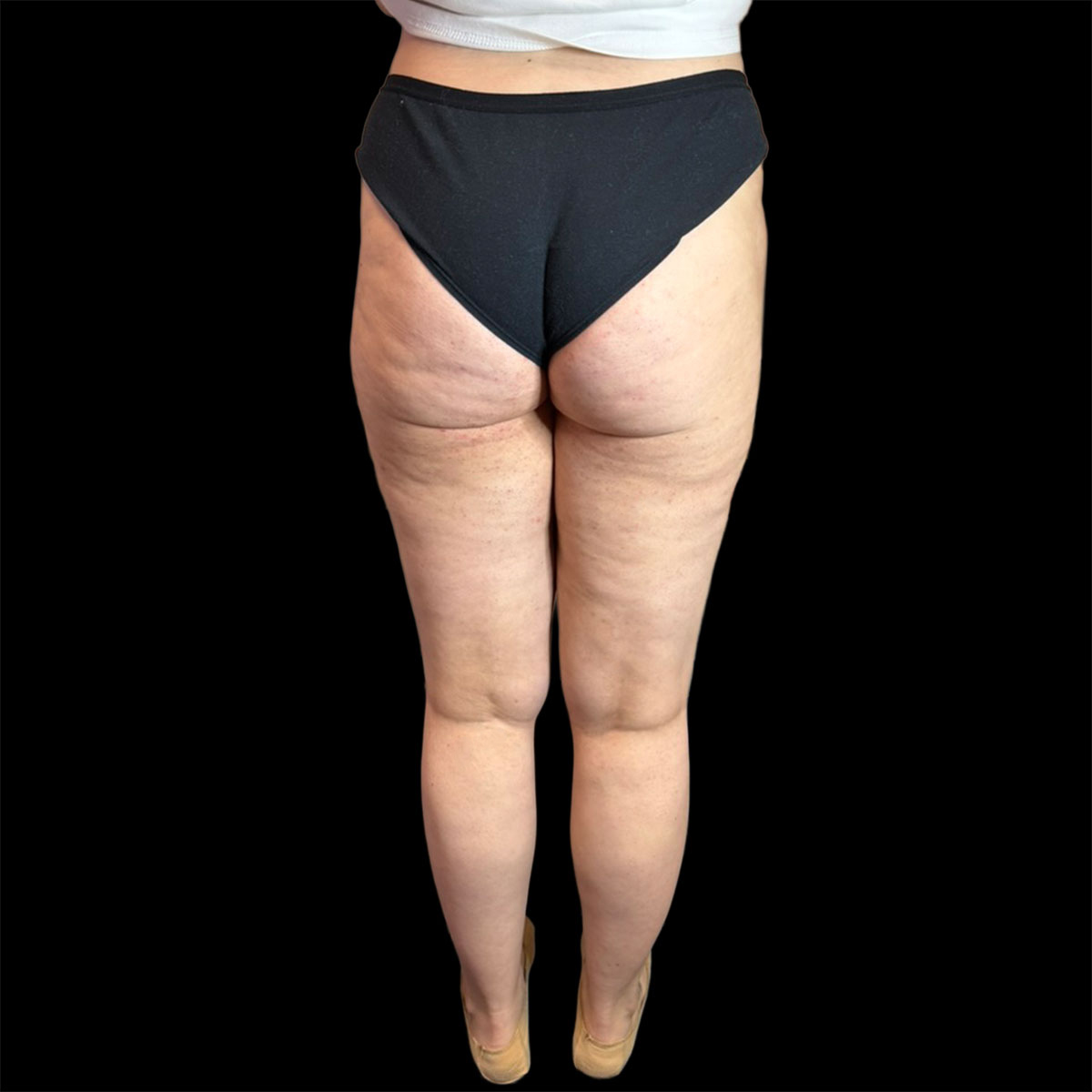 Lipedema di II tipo, IV stadio, dopo della liposuzione