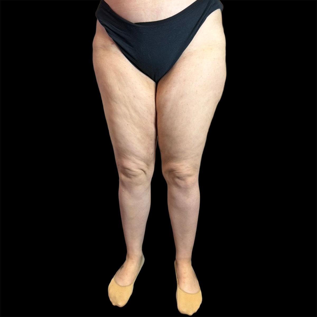 Lipedema di II tipo, IV stadio, dopo della liposuzione