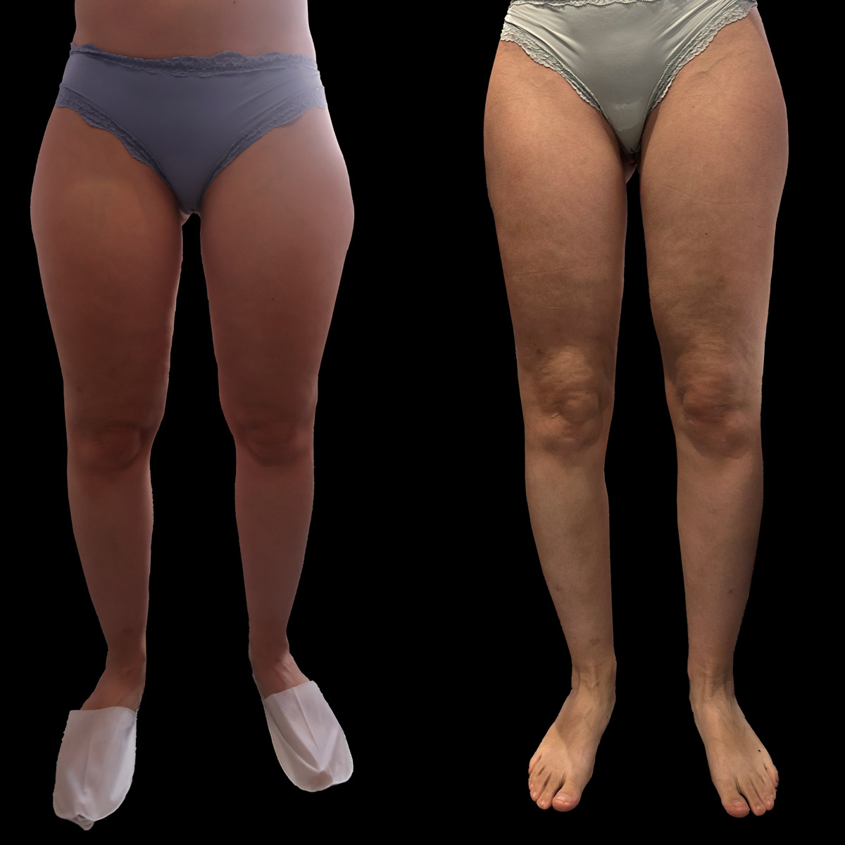 Liposuzione per il lipedema