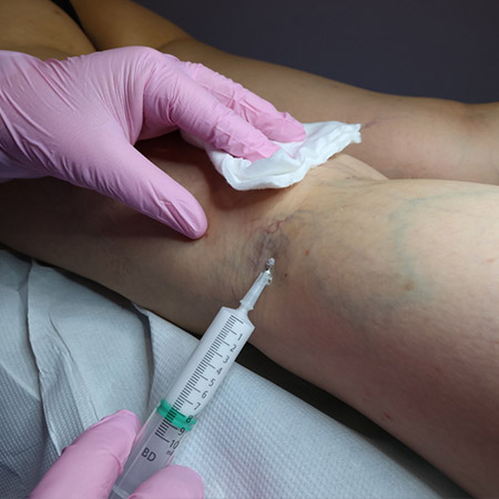 Scleromousse: preparazione della gamba del paziente